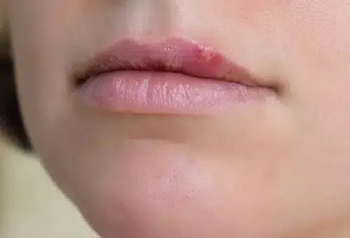 Nahaufnahme von menschlichen Lippen. Das Bild zeigt den unteren Teil eines Gesichts, fokussiert auf den Mund. Die Lippen sind leicht geöffnet und haben eine natürliche rosa Färbung. Die Haut um den Mund herum ist hell und glatt. Das Bild ist sehr detailliert und zeigt die feine Textur der Lippen und der umliegenden Haut.